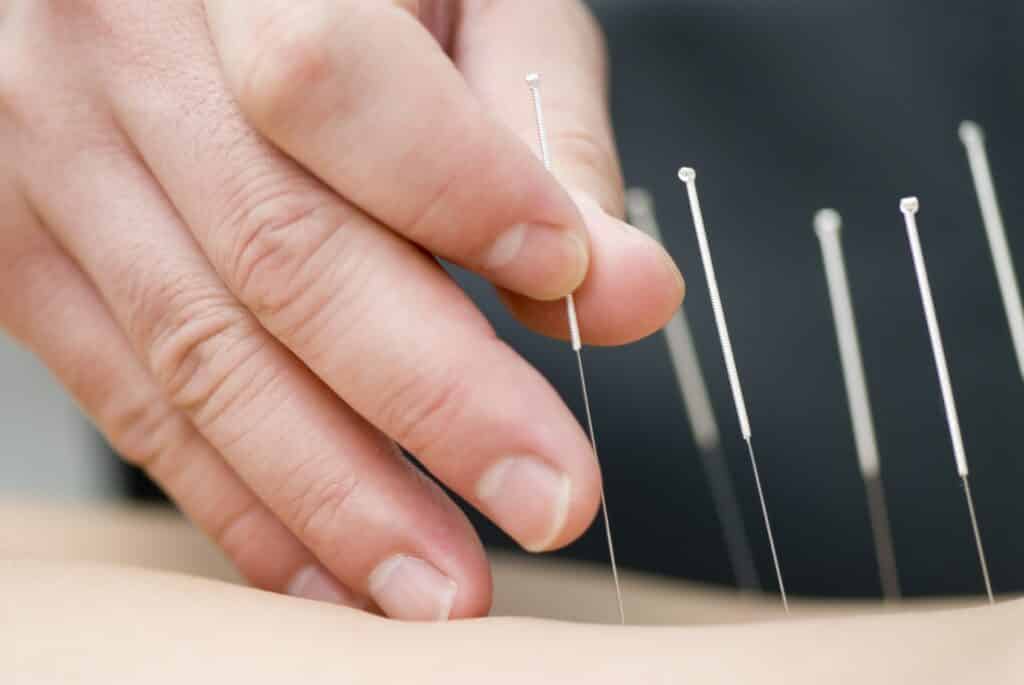 Doctor uses dry needles for treatment of the patient